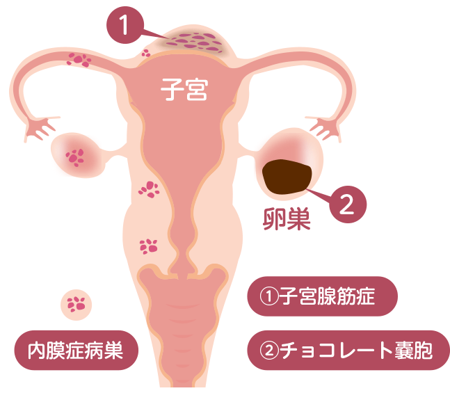 子宮内膜症・子宮腺筋症